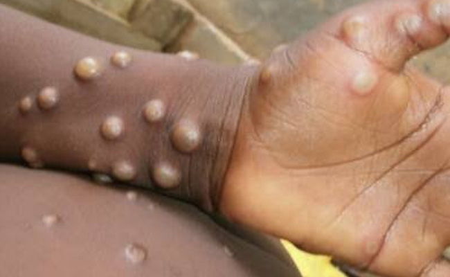 Centre confirms presence of Mpox virus 