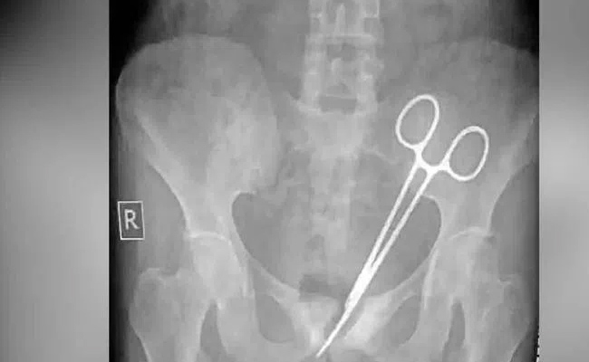 Surgical Scissors Removed After 12 Years in Sikkim